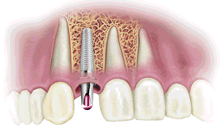 dental-implants-4-restorative-dentistry-masterton-dental-clinic