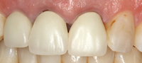 dental-crowns-4a-prosthetic-dentistry-masterton-dental-clinic