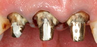dental-crowns-4b-prosthetic-dentistry-masterton-dental-clinic