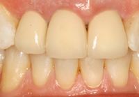 dental-crowns-4c-prosthetic-dentistry-masterton-dental-clinic